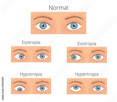 Crossed Eyes Vector Illusration Types Of Crossed Eyes Stock Vector