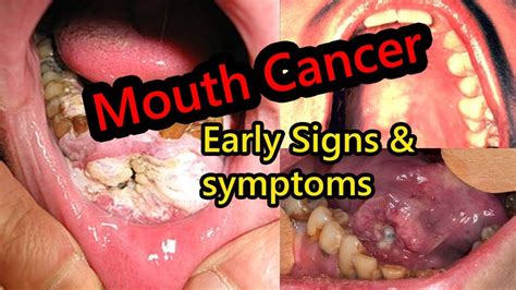 Early Warning Signs Of Mouth Cancer Most People Ignore Youtube
