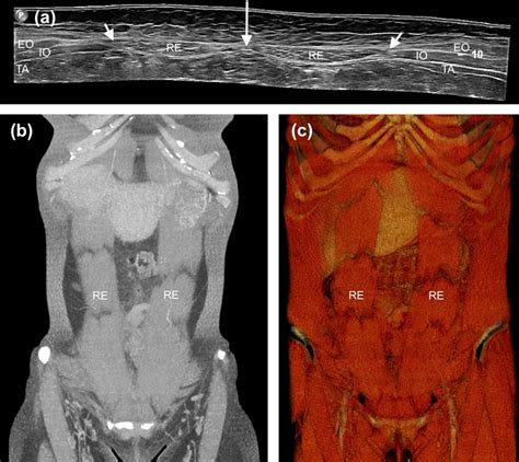 The Panoramic Axial Ultrasound Image A Shows The Anterior Abdominal