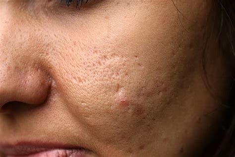 How To Care For Acne Scars Mederma