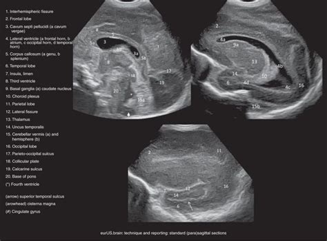 State Of The Art Neonatal Cerebral Ultrasound Technique And Reporting