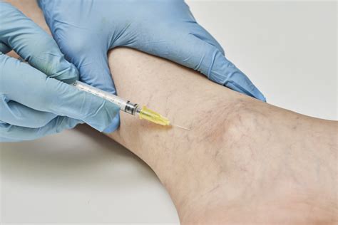 Ultrasound Guided Sclerotherapy Vs Visual Sclerotherapy