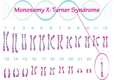 Turner Syndrome Karyotype Monosomy X 7818639 Vector Art At Vecteezy