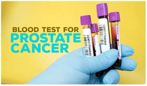 Genetics And Cancer Blood Test For Prostate Cancer Cancerpen