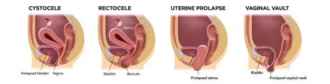 Can Pelvic Floor Therapy Help Prolapse