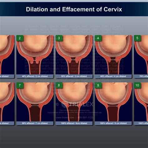 Dilation And Effacement Of Cervix Trialexhibits Inc
