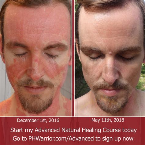 Healing Before After Face Psoriasis A Warrior Curing Psoriasis Naturally