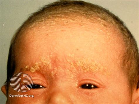 Cradle Cap The London Skin And Hair Clinic