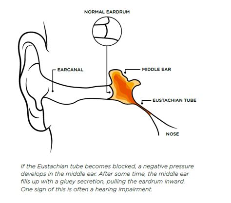 Everything You Need To Know About Glue Ear Infographic Otovent