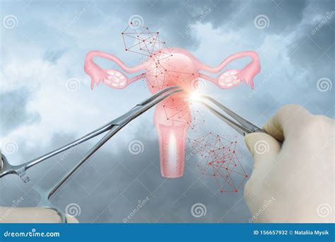 The Concept Of Surgical Treatment Of The Uterus Stock Photo Image Of