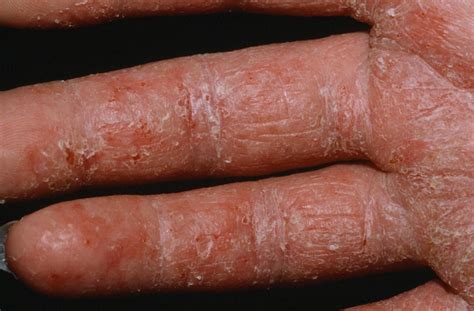 Dermatitis Contact Atopic Perioral Nummular Seborrheic Stasis