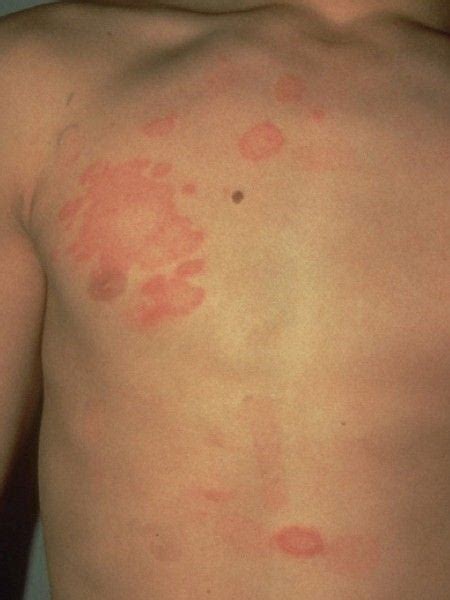 Fungal Infections Of The Skin Dermatologist In Pensacola Fl Summit