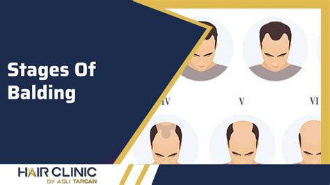 Stages Of Balding Hairclinic By Aslı Tarcan Hair Transplant