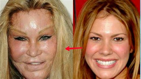 Martha Sugalski Before And After Plastic Surgery Celebrity Plastic
