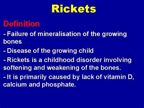 Rickets Rickets Definition Failure Of Mineralisation Of The