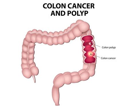 Colorectal Cancer Causes Symptoms And Treatments