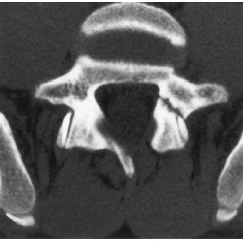 Reverse Gantry Ct Showing Bilateral Spondylolysis At L5 In A 20 Year