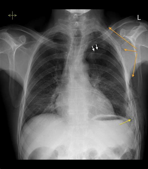 tension pneumothorax due  rib fracture radiology  st vincents
