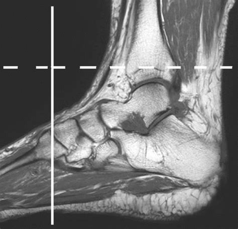The mri scanner is a tube surrounded by a giant circular magnet. Foot Muscles Mri Anatomy : Mri Of The Ankle Detailed Anatomy W Radiology / In flat foot ...