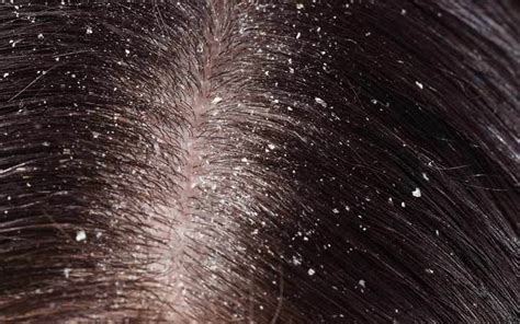 How To Prevent Dandruff At Home 7 Easy Remedies