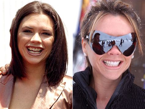 Celebrity Veneers Celebrities With Veneers Before And After