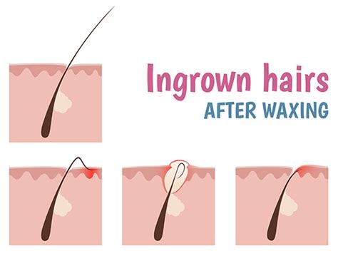5 how long does my hair have to be? Home Remedies to Get Rid of Ingrown Hair - Boldsky.com