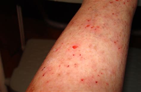 Effective Treatments For Morgellons Disease Timesocket