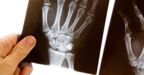 Diagnosing And Treating Scaphoid Fractures Of The Wrist Scaphoid Fracture Wrist Injury