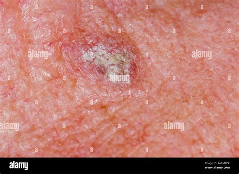 Close Up Of A Solar Keratosis On The Skin In A 77 Year Old Male Patient