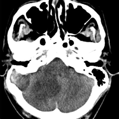 A Intraoperative View Of The Epidermoid Cyst In The Mastoid Region