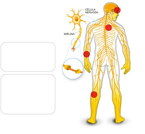 It mainly affects the feet, hands and limbs, causing problems such as numbness, weakness and pain. Pacientes de Guillain-Barré têm inflamação até no cérebro ...