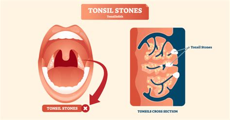 Tonsil Stones Ent Doctor Shares 4 Ways To Get Rid Of These Stinky Masses