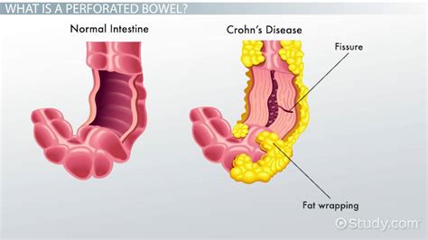 Perforated Bowel Definition Symptoms And Causes Lesson