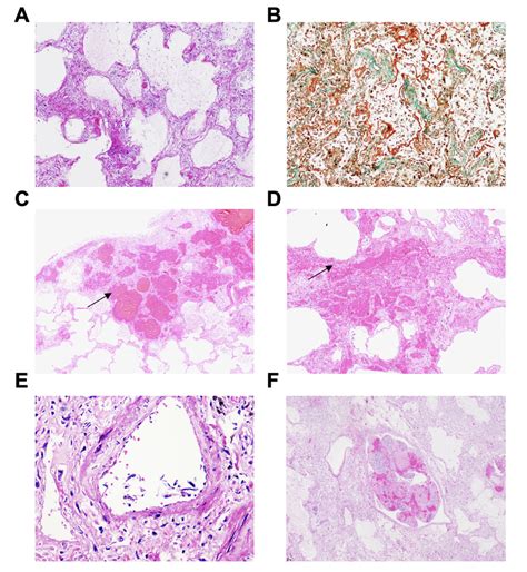 Fig S2 Hyaline Membrane Formation Hemorrhage And Thrombosis Hyaline