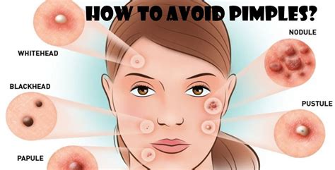 How To Avoid Pimples Causes Symptoms And Rid Of Acne