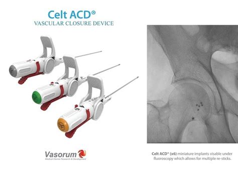 Vasorum Launches Celt Acd Second Generation Vascular Closure Device In