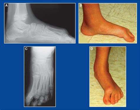 Foot And Ankle Deformities Musculoskeletal Key
