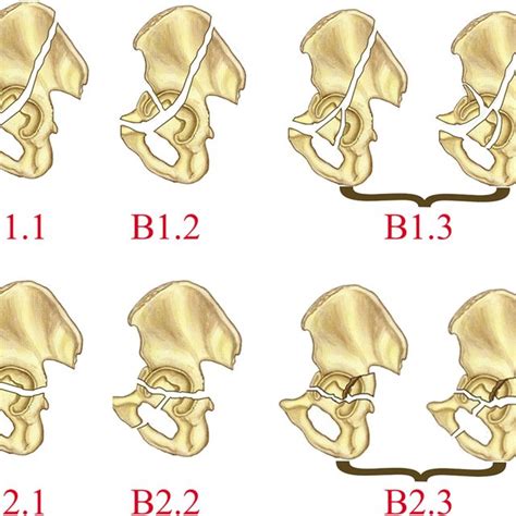 Pdf Three Column Classification For Acetabular Fractures