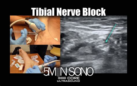 Posterior Tibial Nerve Block Core Ultrasound