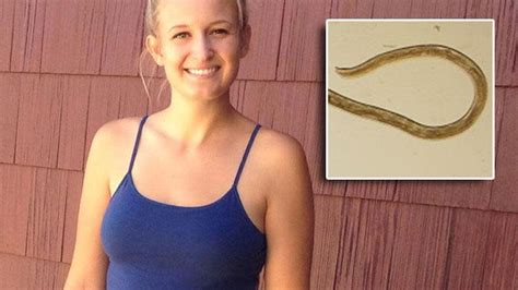Woman Has 14 Parasitic Worms Removed From Her Eye