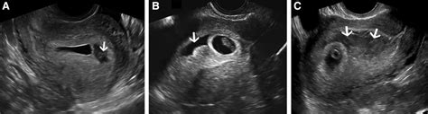 Subchorionic Hematoma Correlation Of Grading Techniques With First