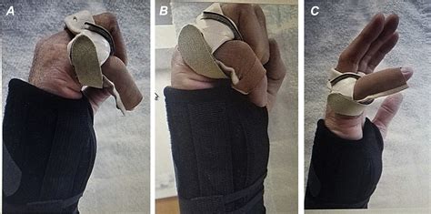 Use Of A Relative Motion Flexion Orthosis For Postoperative Management