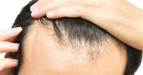 9 Receding Hairline Treatment Female Article