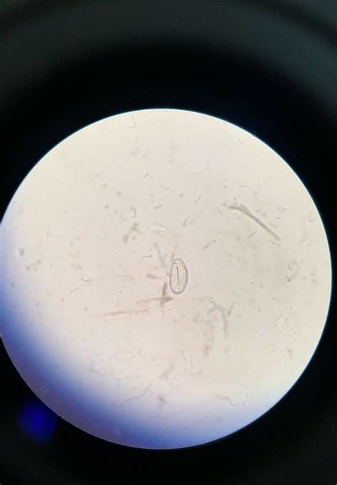 Enterobius Vermicularis In Microscopic Examination Of 7 Year MEDizzy