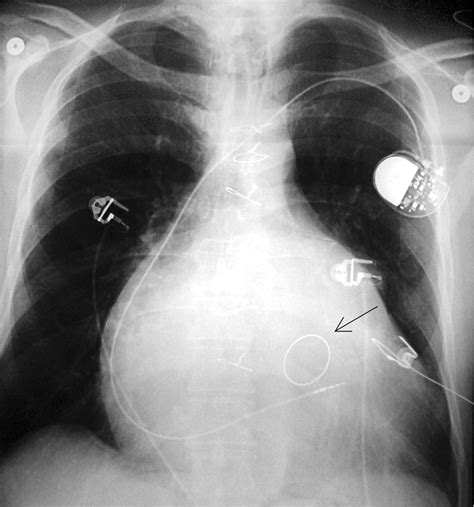 Medical Devices Of The Chest Radiographics