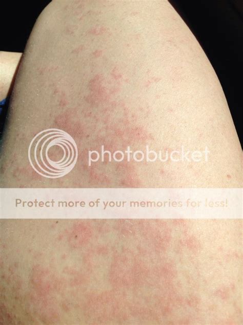 Hives On Legs Pictures Photos