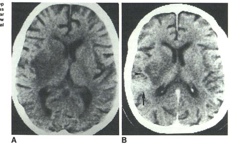 Figure 3 From Ct Features Of Early Listeria Monocytogenes Cerebritis