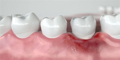 The Stages Of Gum Disease Sterling Va Gingivitis