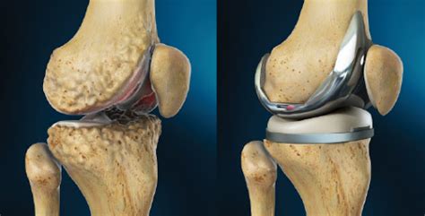 Cementless Total Knee Arthroplasty Rhazes Global