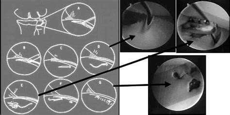 Figure 1 From Disability And Function After Arthroscopic Repair Of